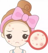西寧哪看治療青春痘好
